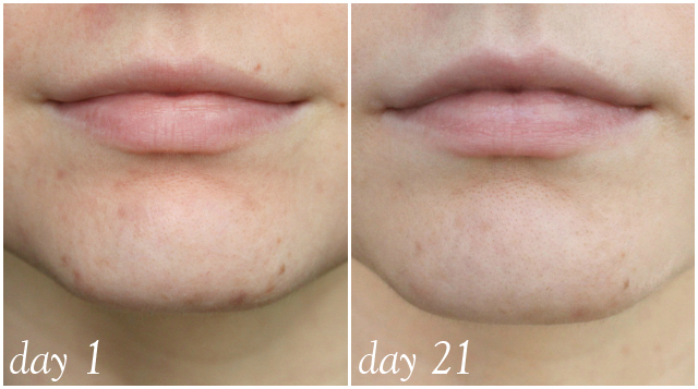 Find out how I finally faded that annoying red patch on my chin by incorporating one new product into my routine - NeoStrata Foaming Glycolic Wash >> http://bit.ly/1ALFxob | via @glamorable