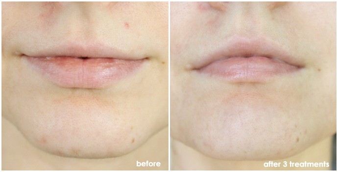 PMD Personal Microderm review