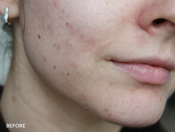 before and after korean skincare routine, acne prone skin, how to fade scars