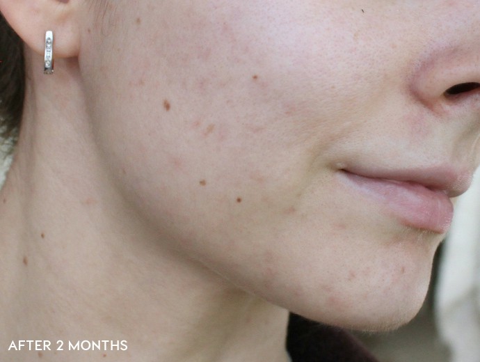 before and after korean skincare routine, acne prone skin, how to fade scars