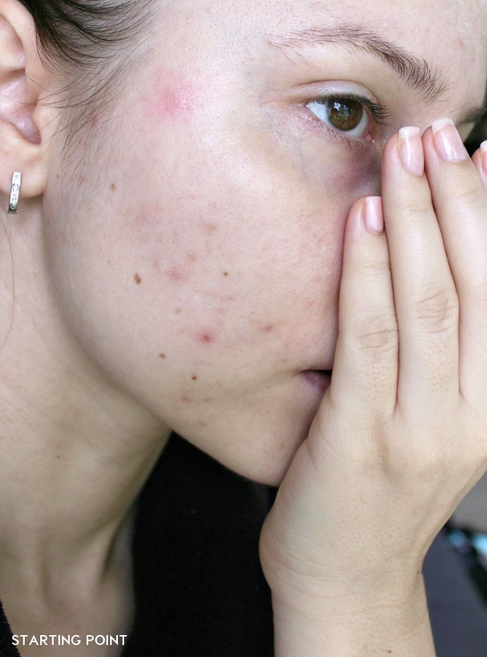 before and after korean skincare routine, acne prone skin, how to fade scars