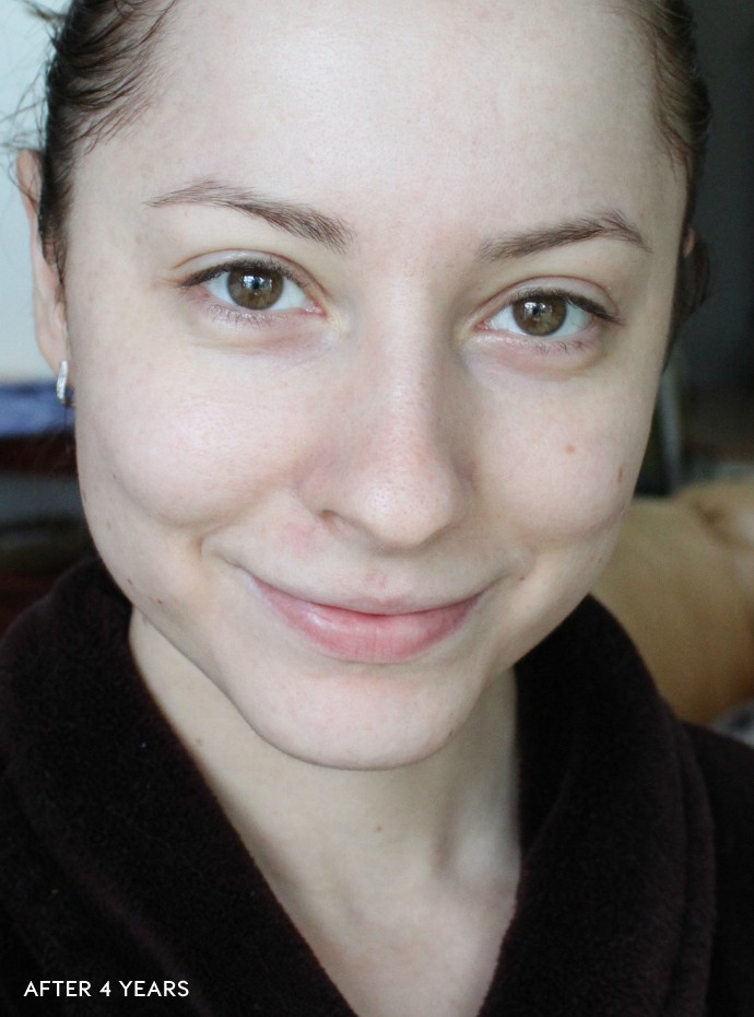 before and after korean skincare routine, acne prone skin, how to fade scars